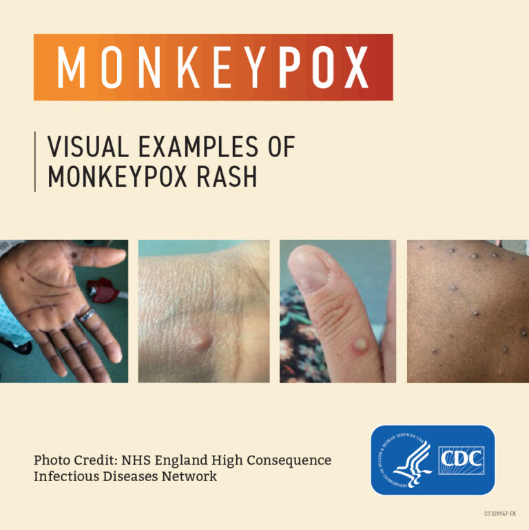 Monkeypox: A Guide for Direct Care Workers | CareAcademy