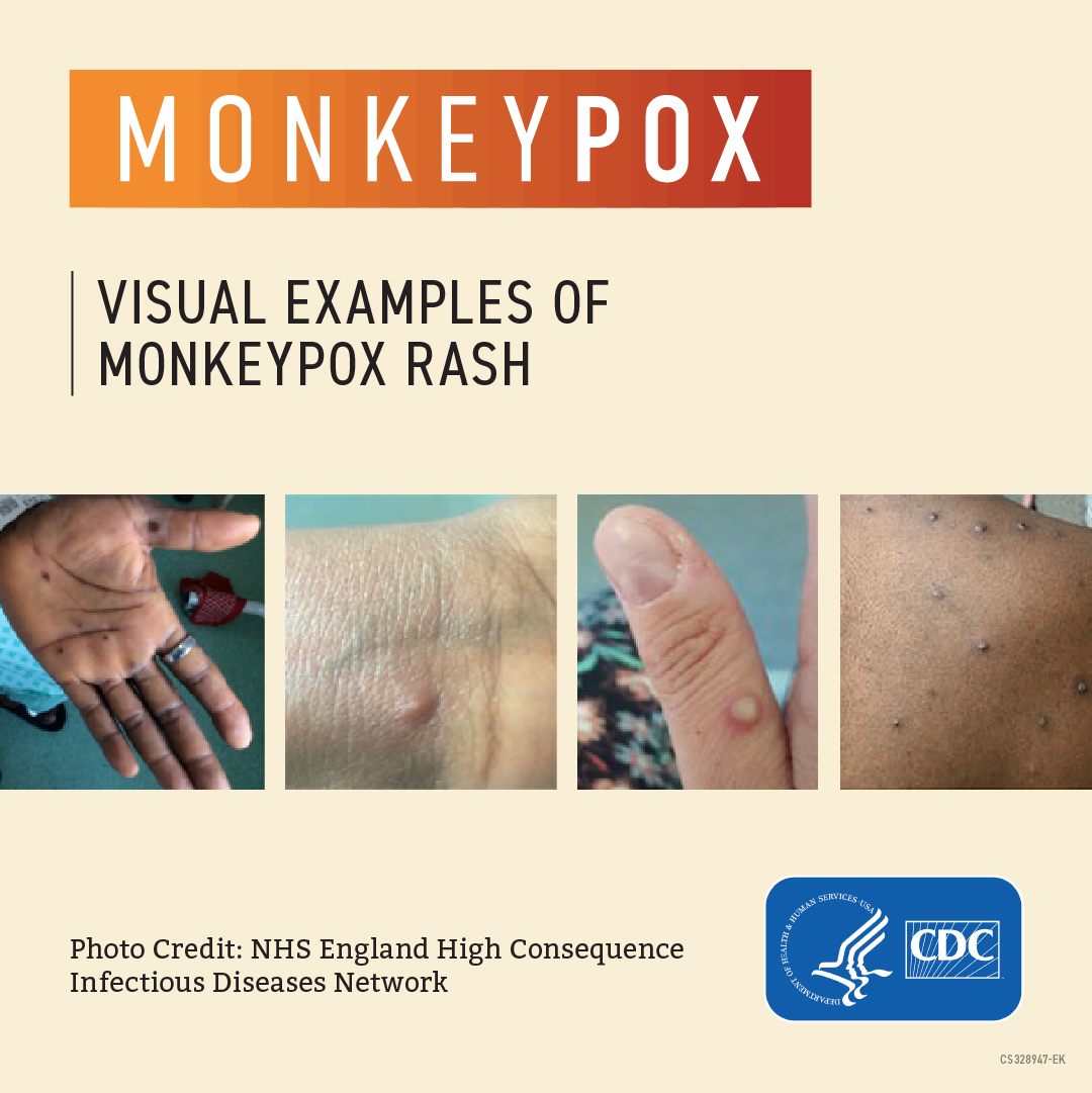 Monkeypox A Guide For Direct Care Workers CareAcademy   Image Mp 003 